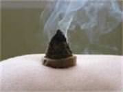 moxibustion